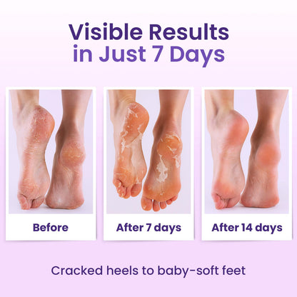 Salicylic and lactic acid foot peel mask application steps illustration