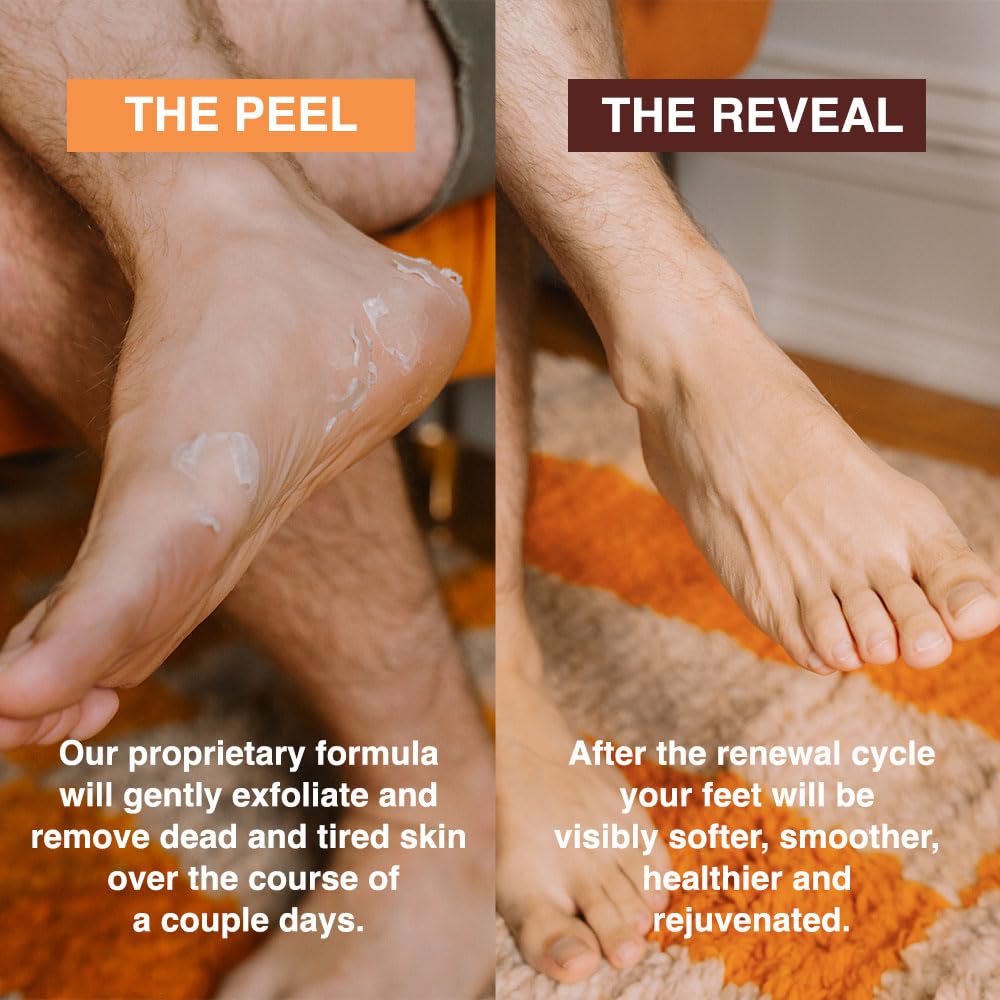 Comparison of dry cracked heels before and after using FEETS exfoliation mask.