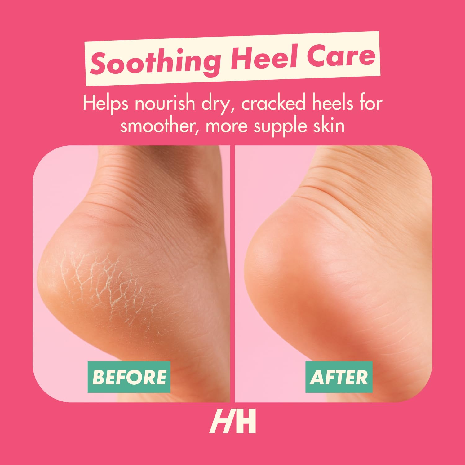 Open-toe moisturizing gel socks worn on feet for cracked heel treatment.