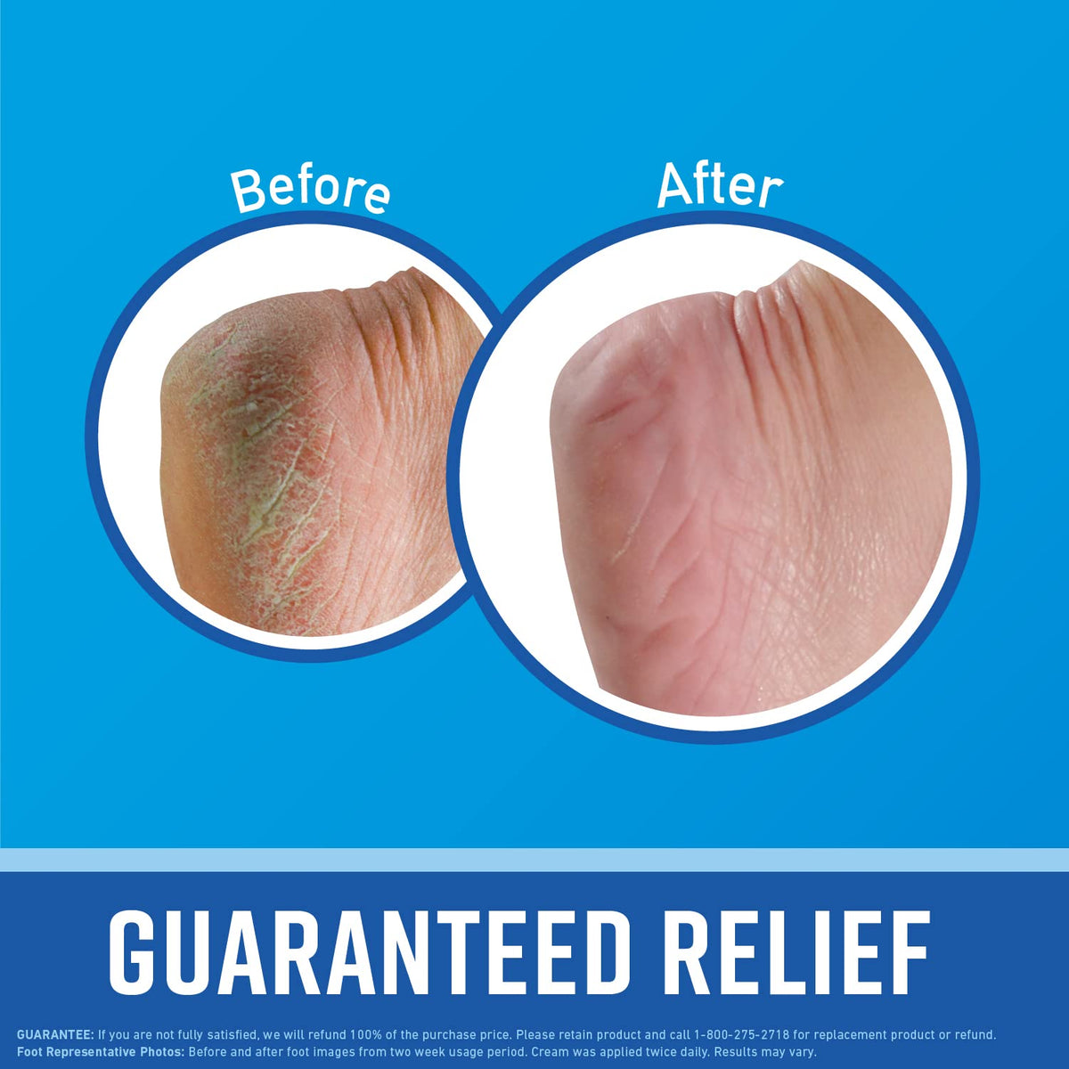 O'Keeffe's foot cream applied on dry heels