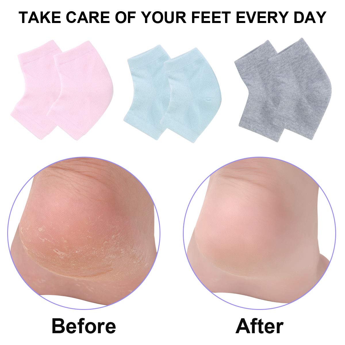 Model wearing Exptolii toeless gel spa socks for cracked heels