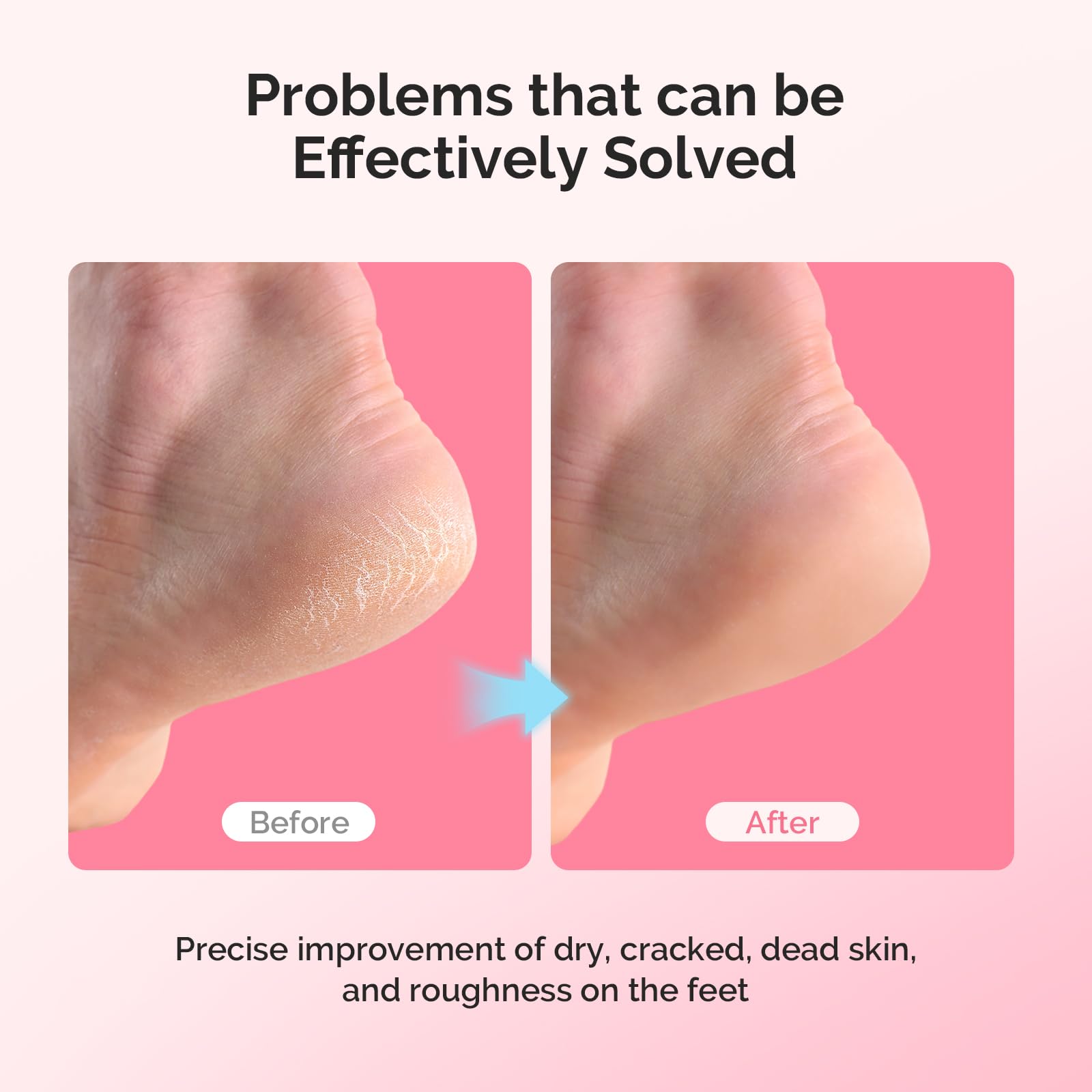 MelodySusie gel lined socks for cracked heel treatment
