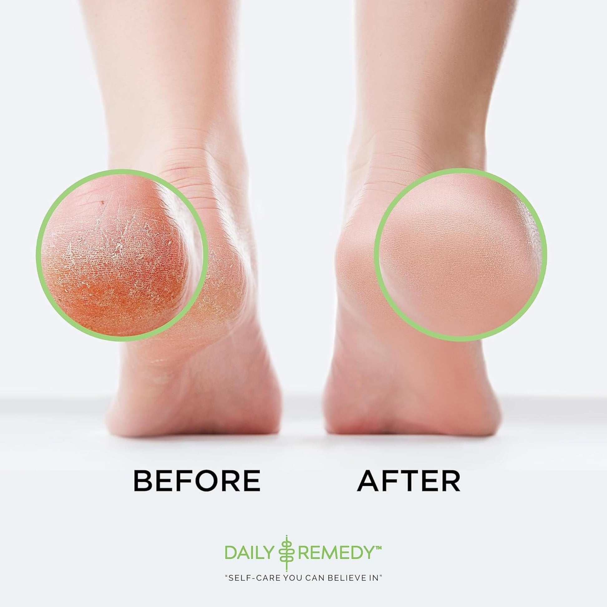 Smooth feet after using Daily Remedy callus treatment
