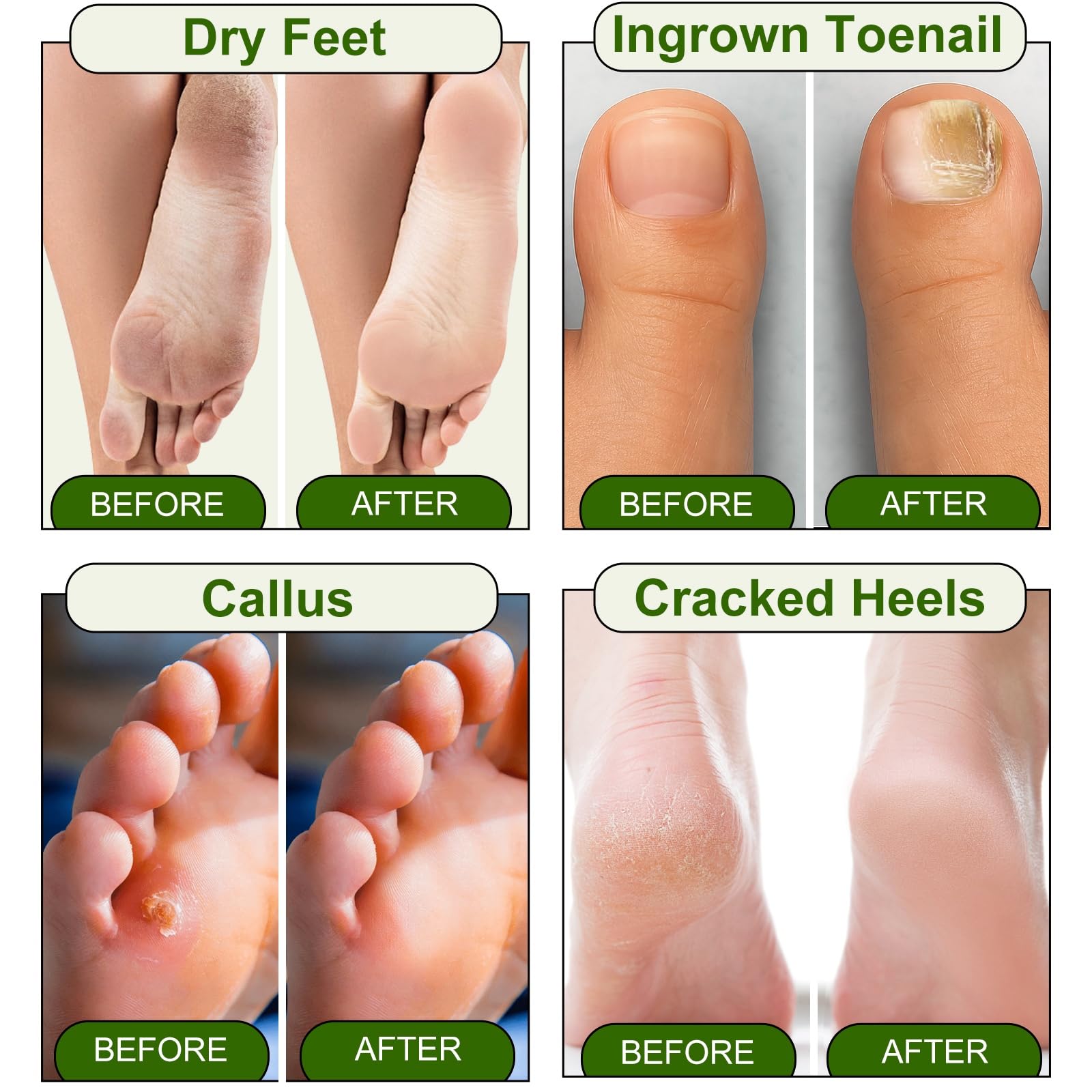 Person using Mr. A foot scrubber on softened heel