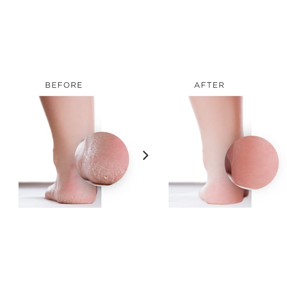 Nu119 foot peeling spray kit for cracked heels and dry skin