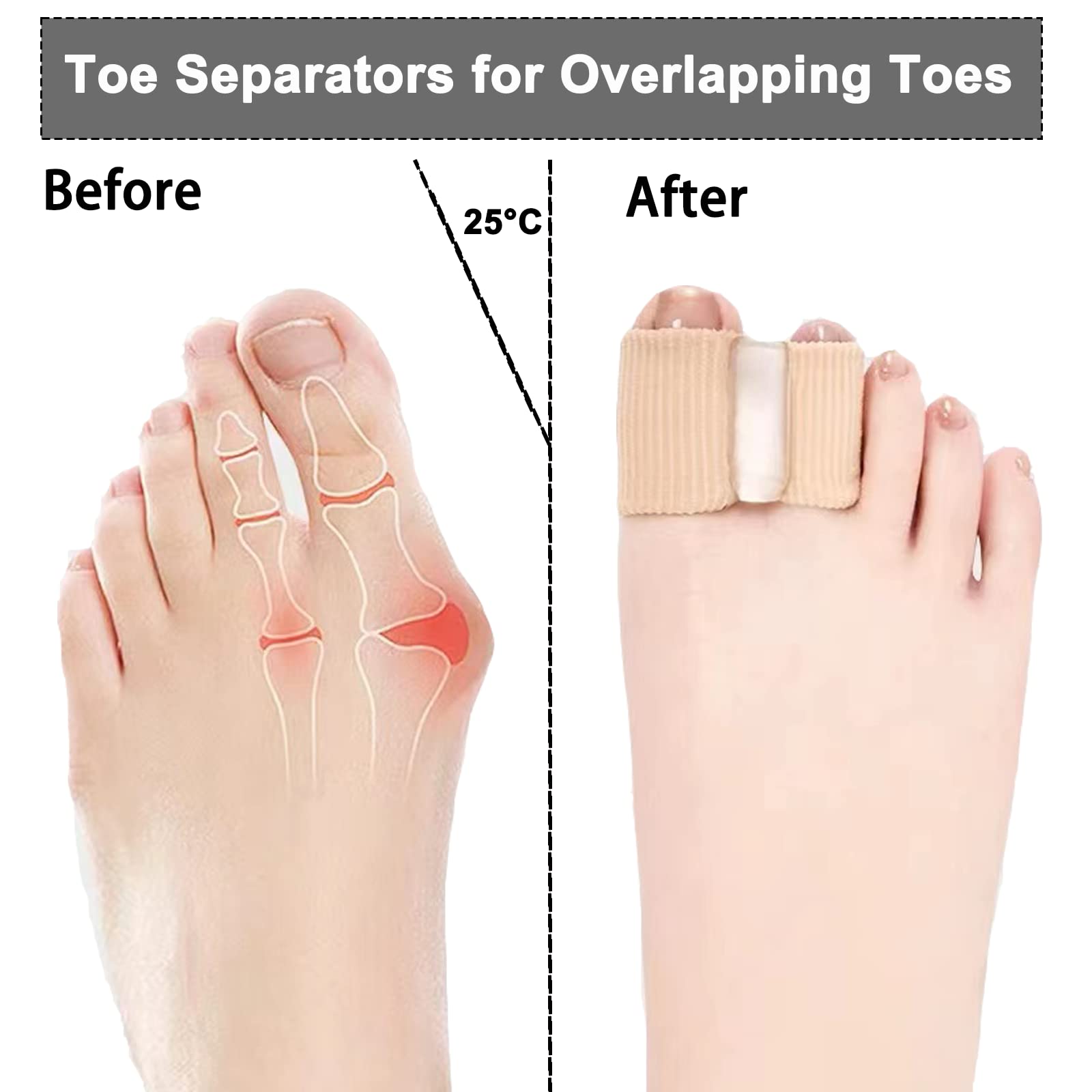Whycalon 12 pack toe spacers for overlapping toes