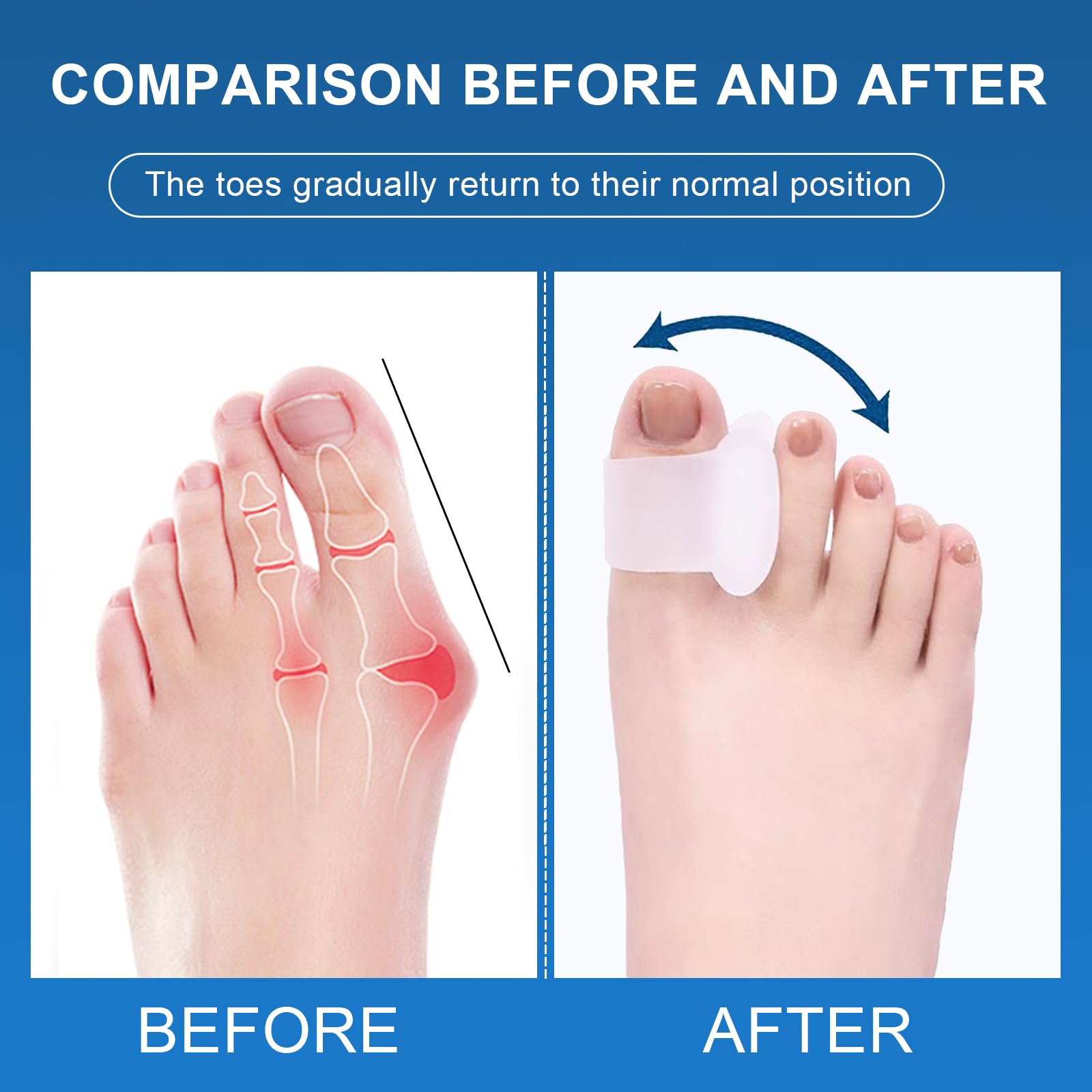 Soft silicone bunion spacer showing flexible material design