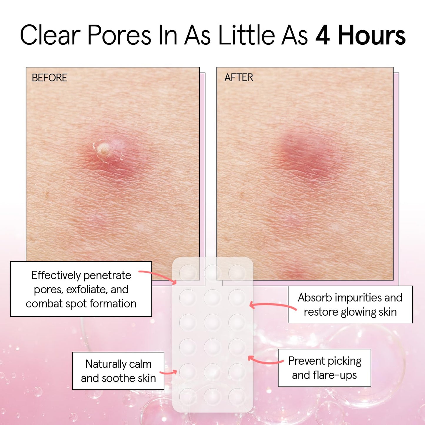 Dermatologist tested vegan pimple patches in packaging