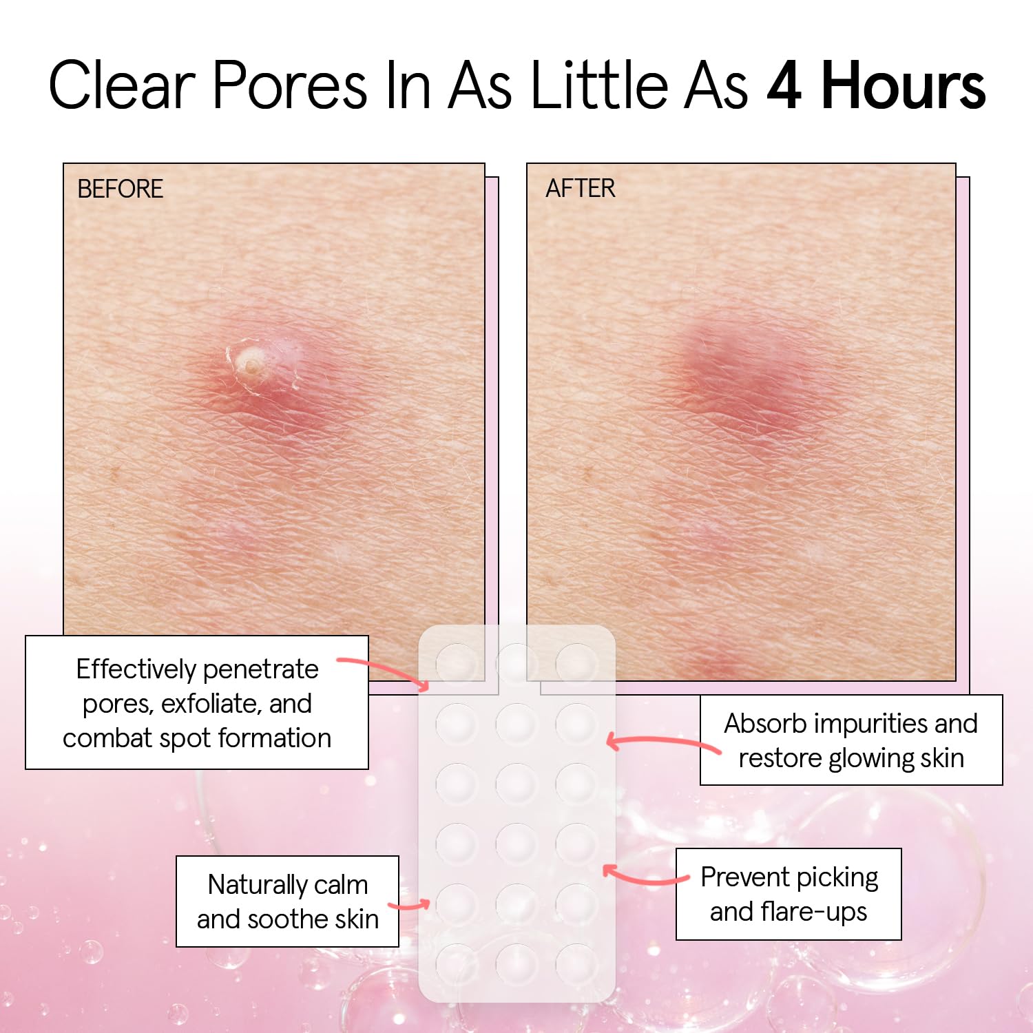 Dermatologist tested vegan pimple patches in packaging