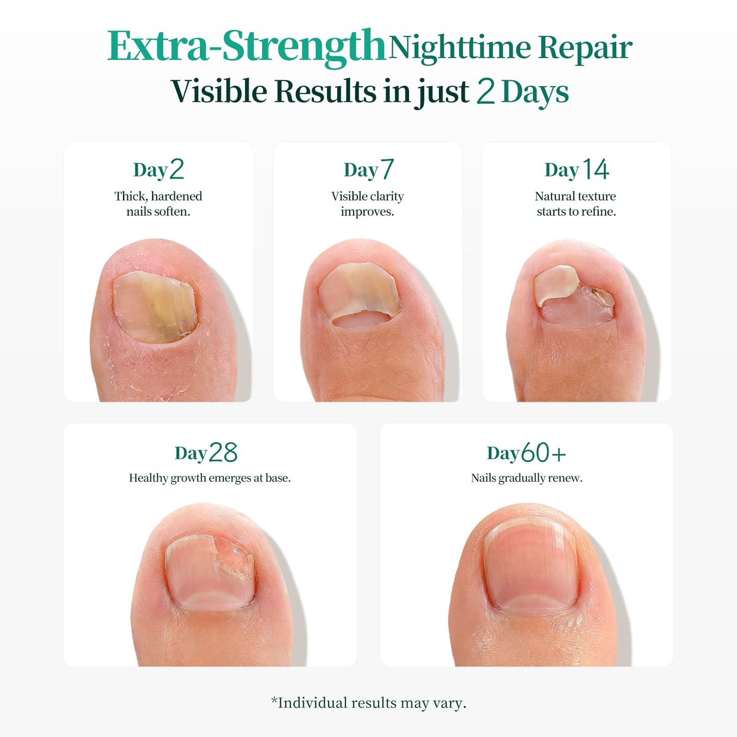 Close up view of the waterproof and breathable APUREE overnight patch applied firmly on a toe.