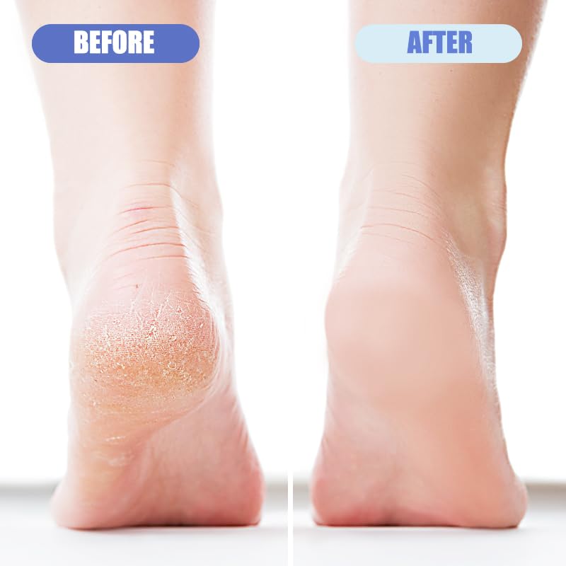 Person using OHOO foot pumice stone on dry heel