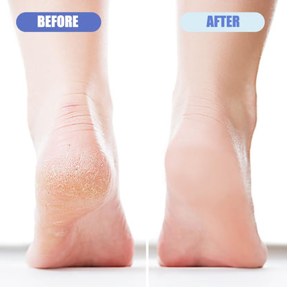 Person using OHOO foot pumice stone on dry heel