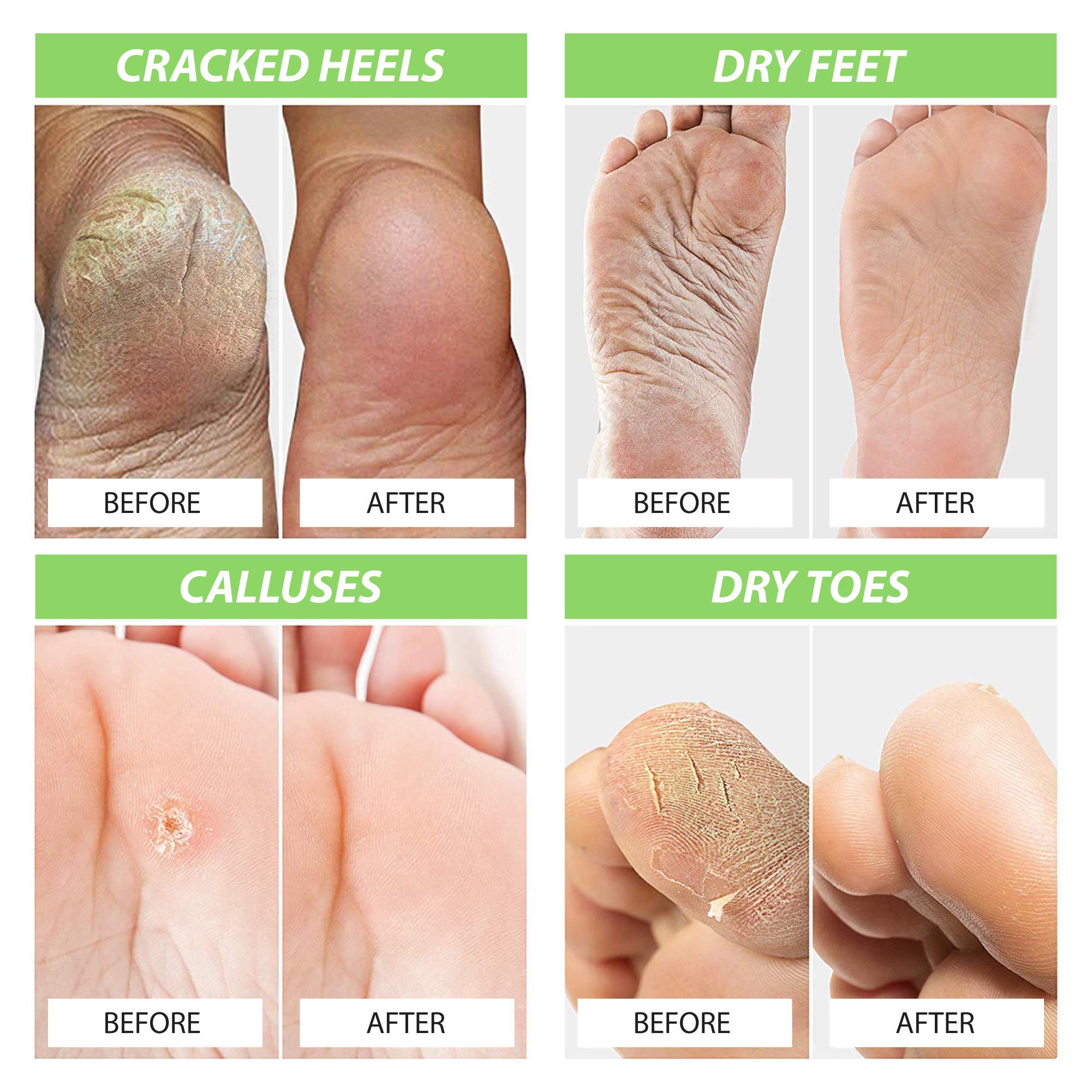 Foot Cure foot soak basin used for home pedicure spa treatment