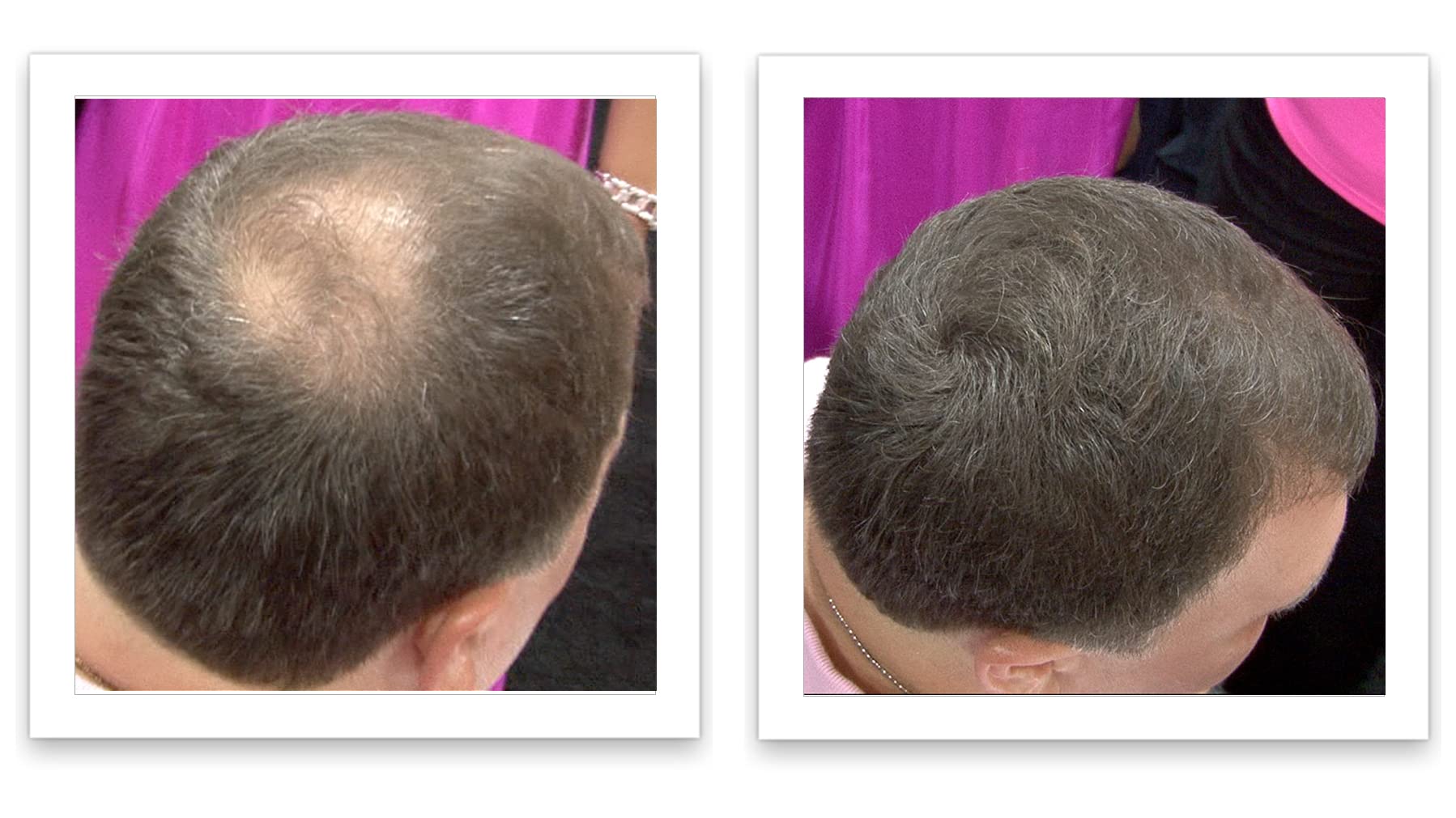 Caboki medium brown hair fibers before and after demonstration