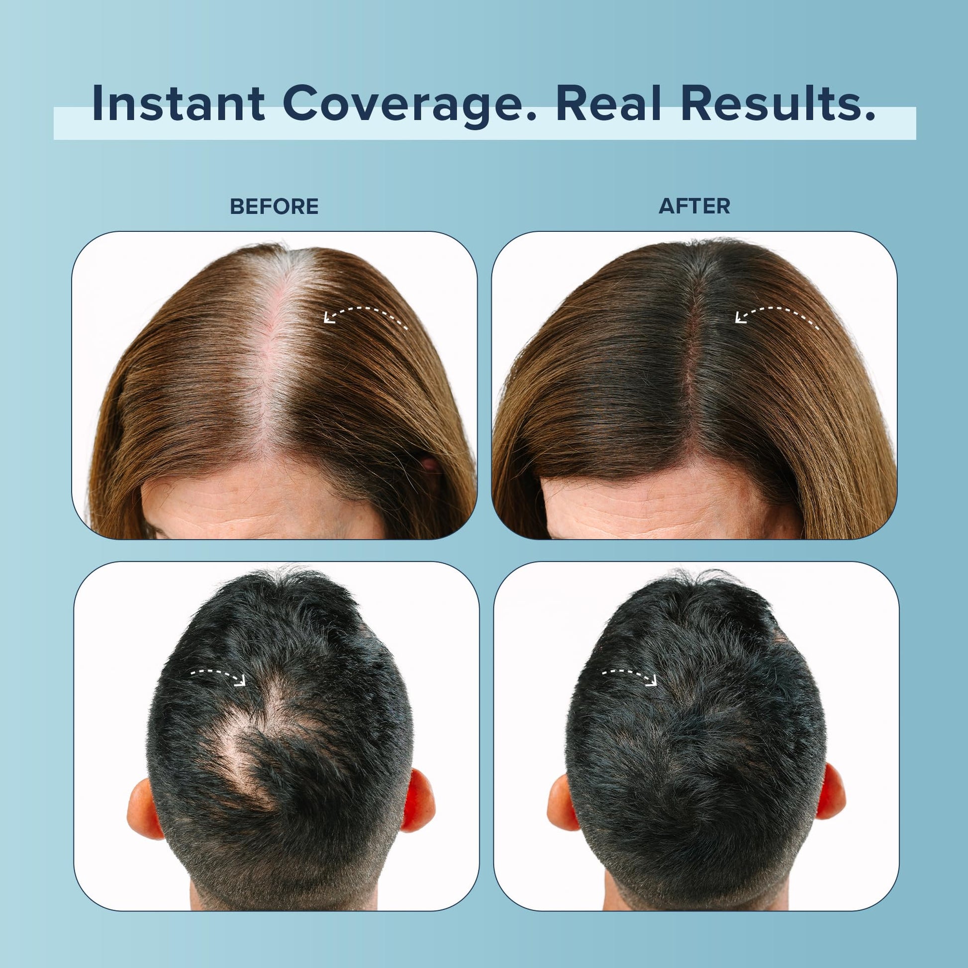 Truhair Dark Brown hair fibers powder applied to the scalp for gray hair coverage.