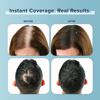 Truhair Dark Brown hair fibers powder applied to the scalp for gray hair coverage.