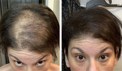 Before and after comparison of a receding hairline filled in with natural hair concealer