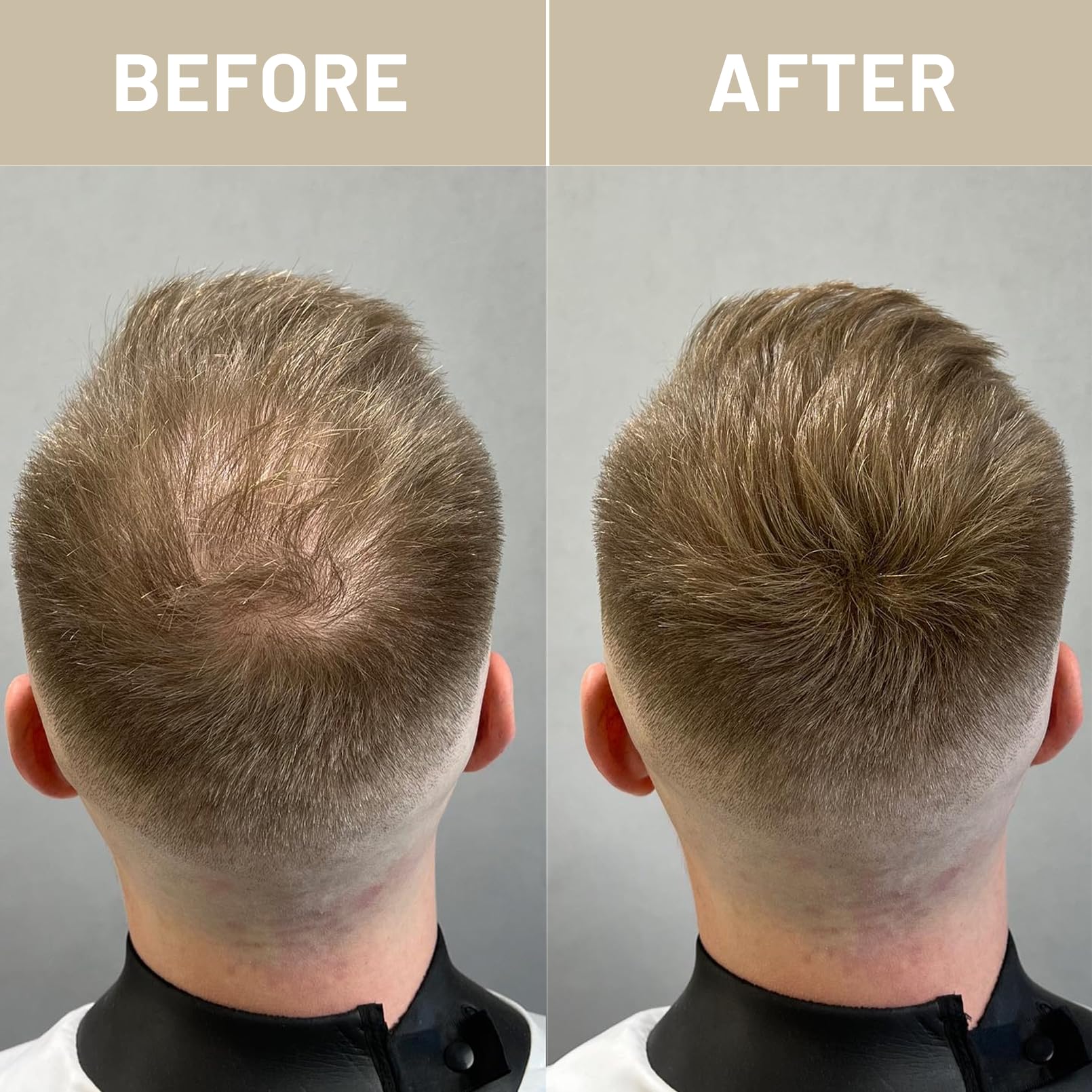 Before and after application demonstration of Volluck hair volumizing fiber powder on a thinning crown