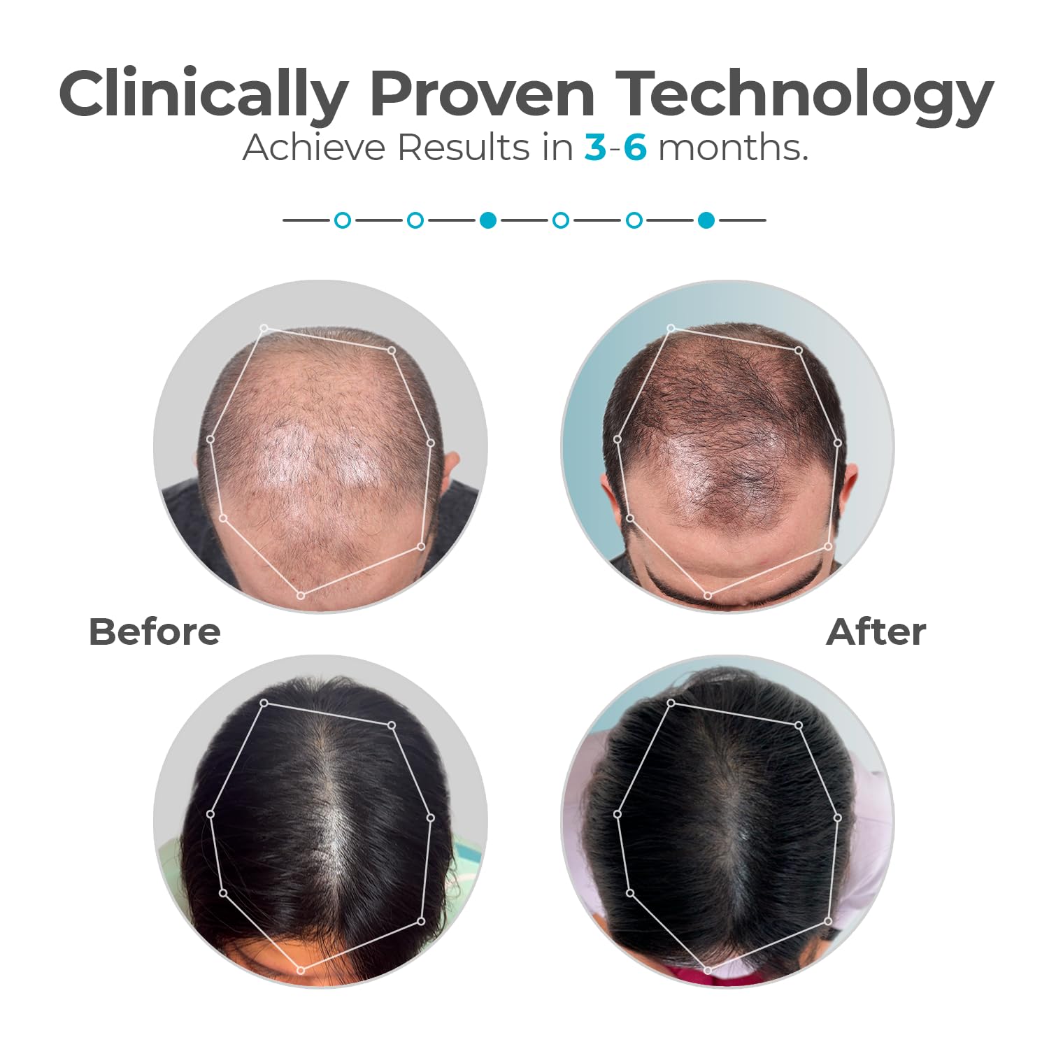 Capillus hair regrowth cap interior laser diode array