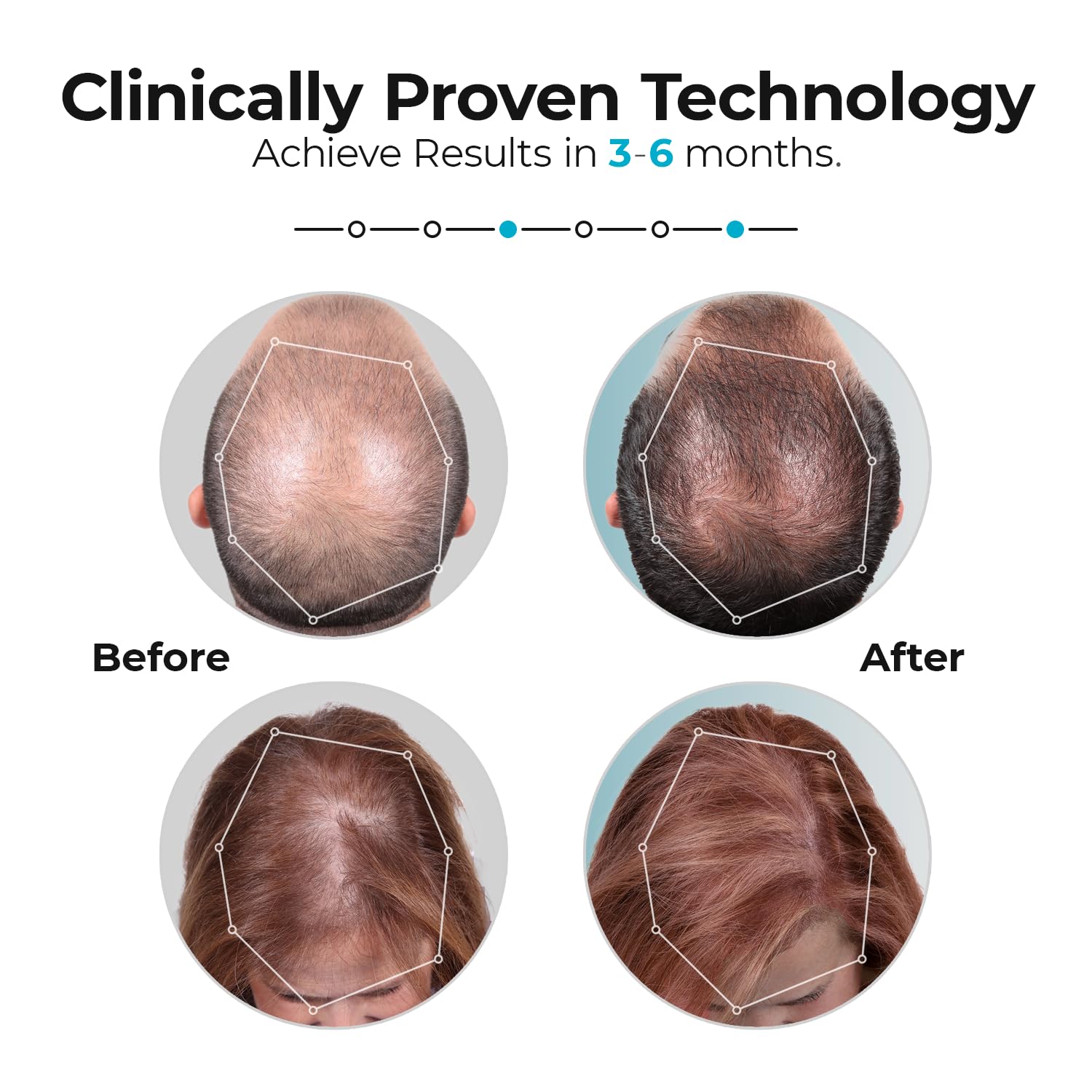 Capillus Pro laser hair regrowth device side profile