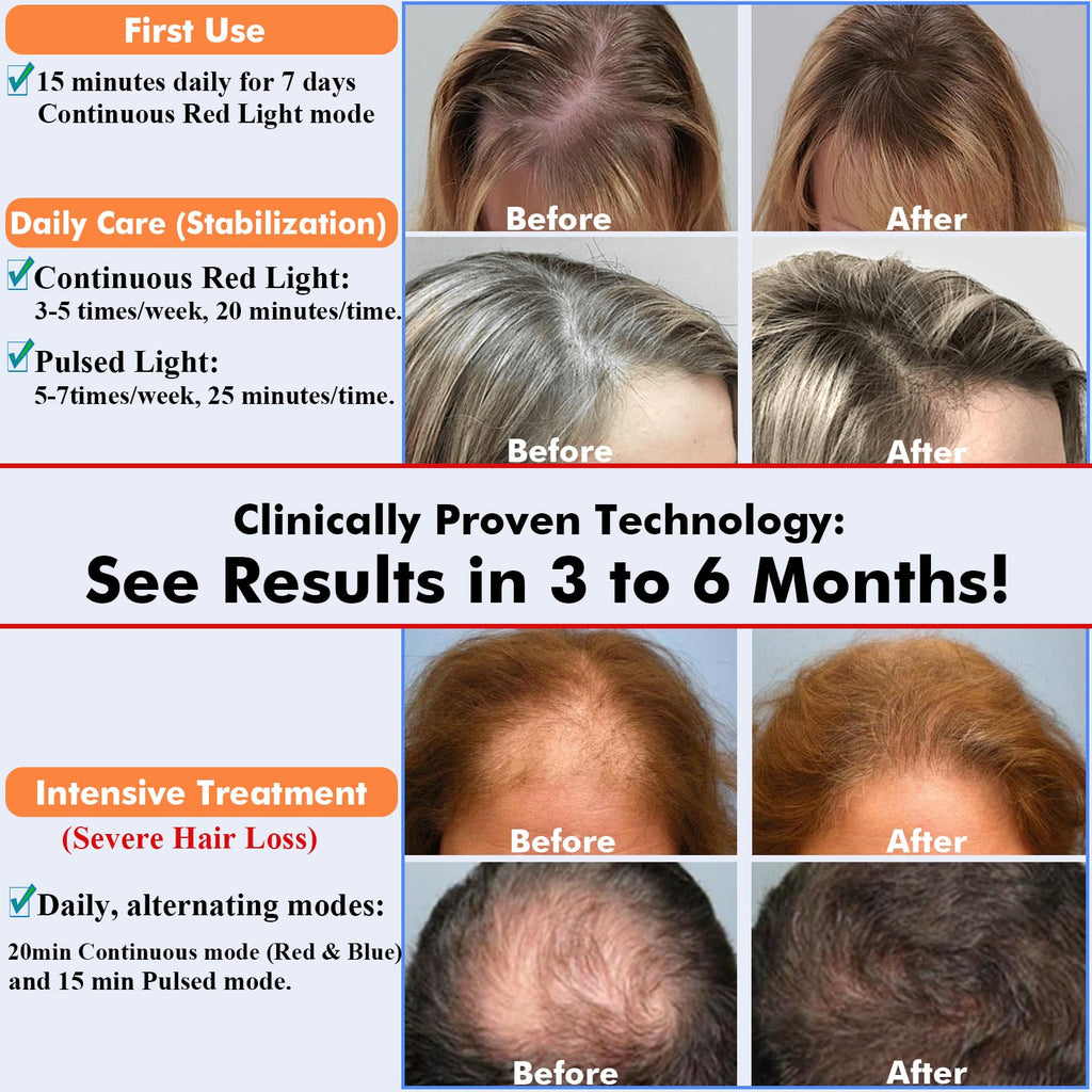 GWODE hair regrowth device worn on head for home use treatment.