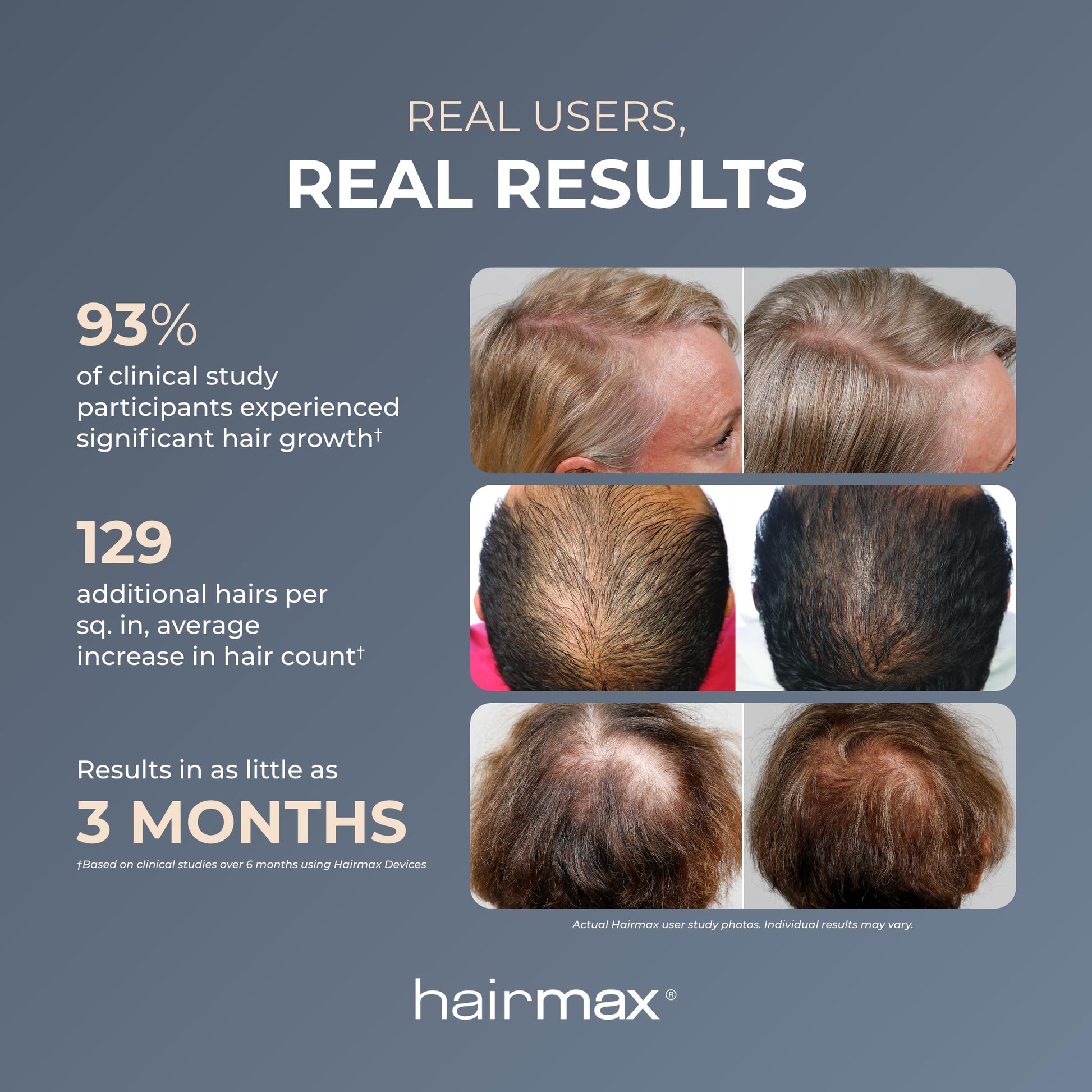 Side profile of Hairmax Powerflex 272 laser therapy cap