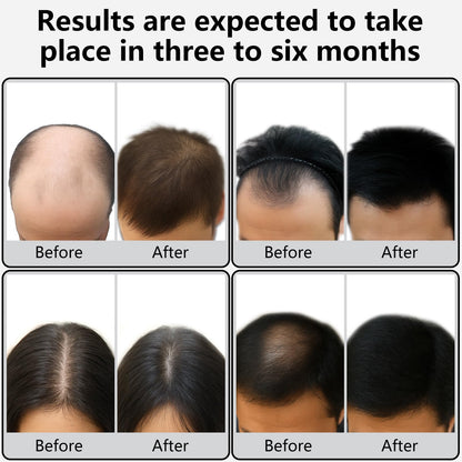 Electric scalp massager bristles for hair density support.