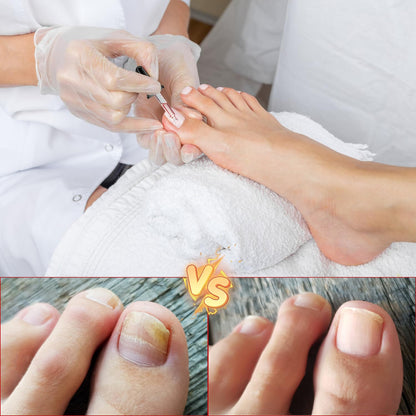Professional ingrown nail care kit for home use
