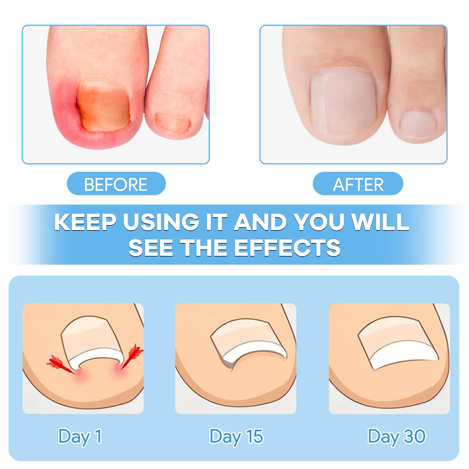 Close up of the breathable cotton curved toenails corrector patch being applied to a toe for alignment.