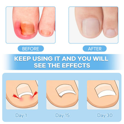 Close up of the breathable cotton curved toenails corrector patch being applied to a toe for alignment.