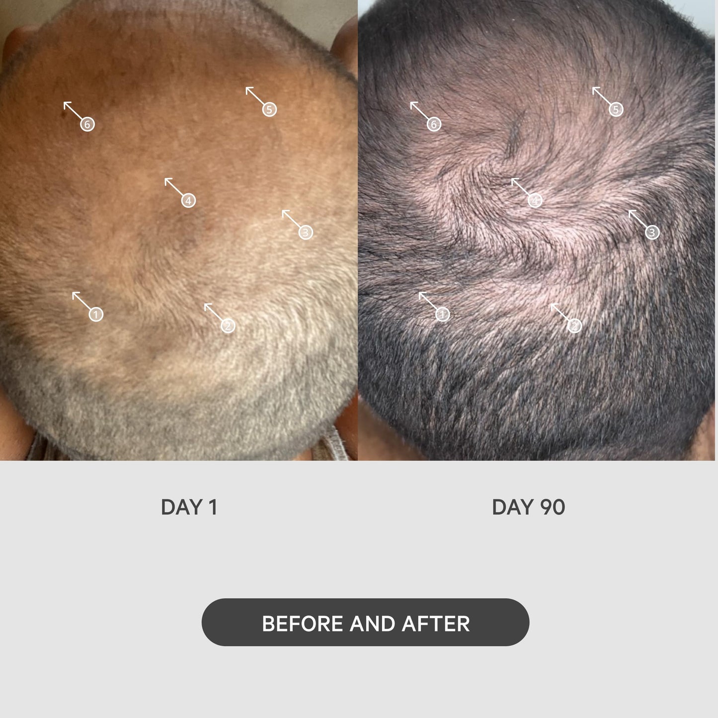 Close up of 0.25mm micro-needle roller head for scalp