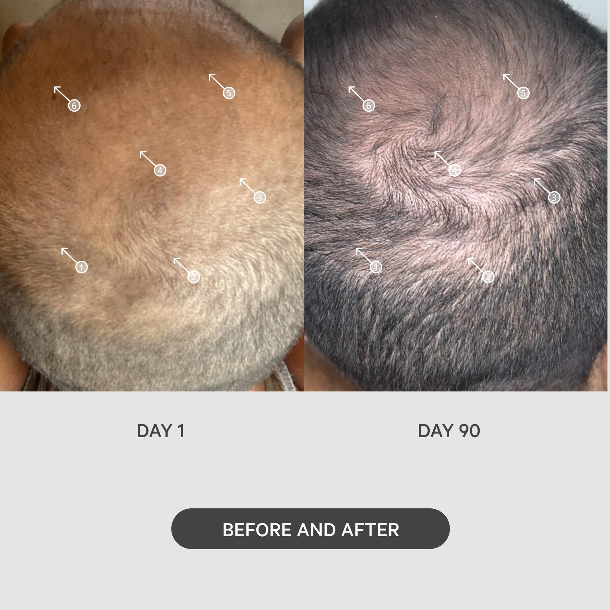 Close up of 0.25mm micro-needle roller head for scalp