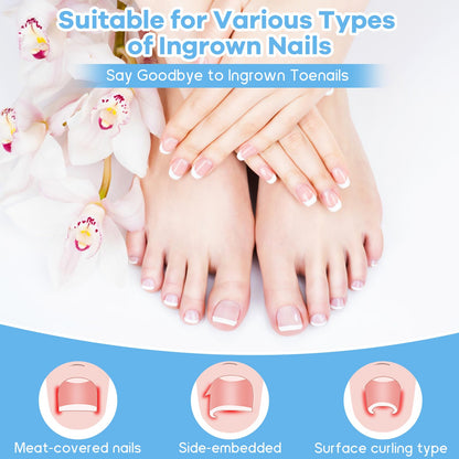 Detailed illustration showing the lever mechanics of the patch straightening a curved toenail to reduce skin pressure.