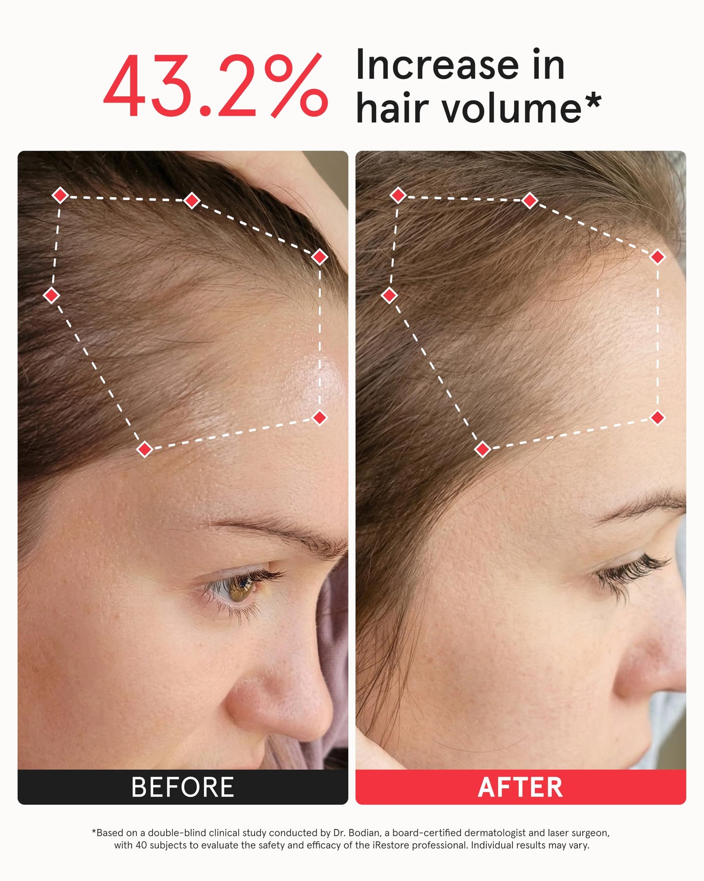Top view of Irestore Professional scalp coverage design