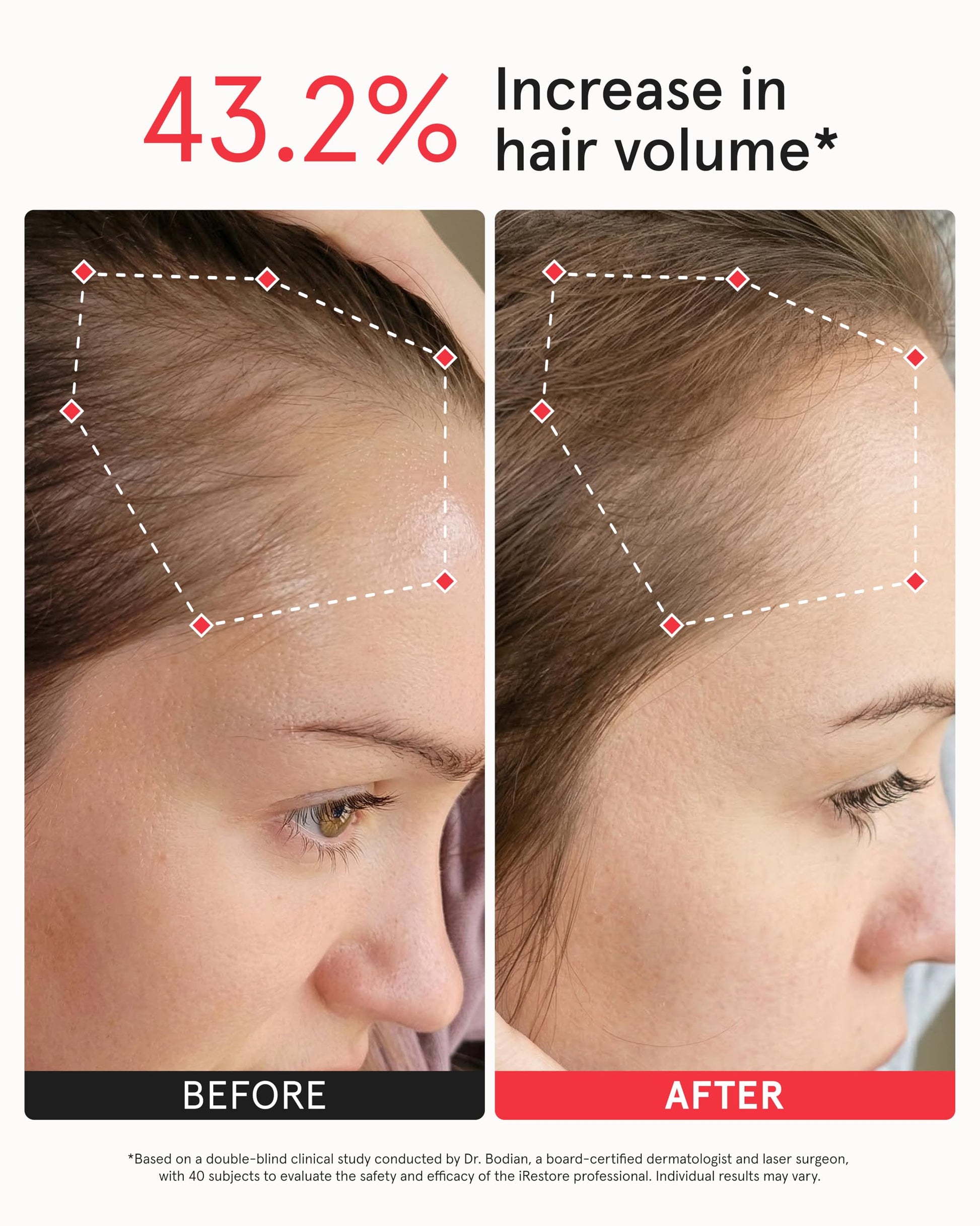 Top view of Irestore Professional scalp coverage design