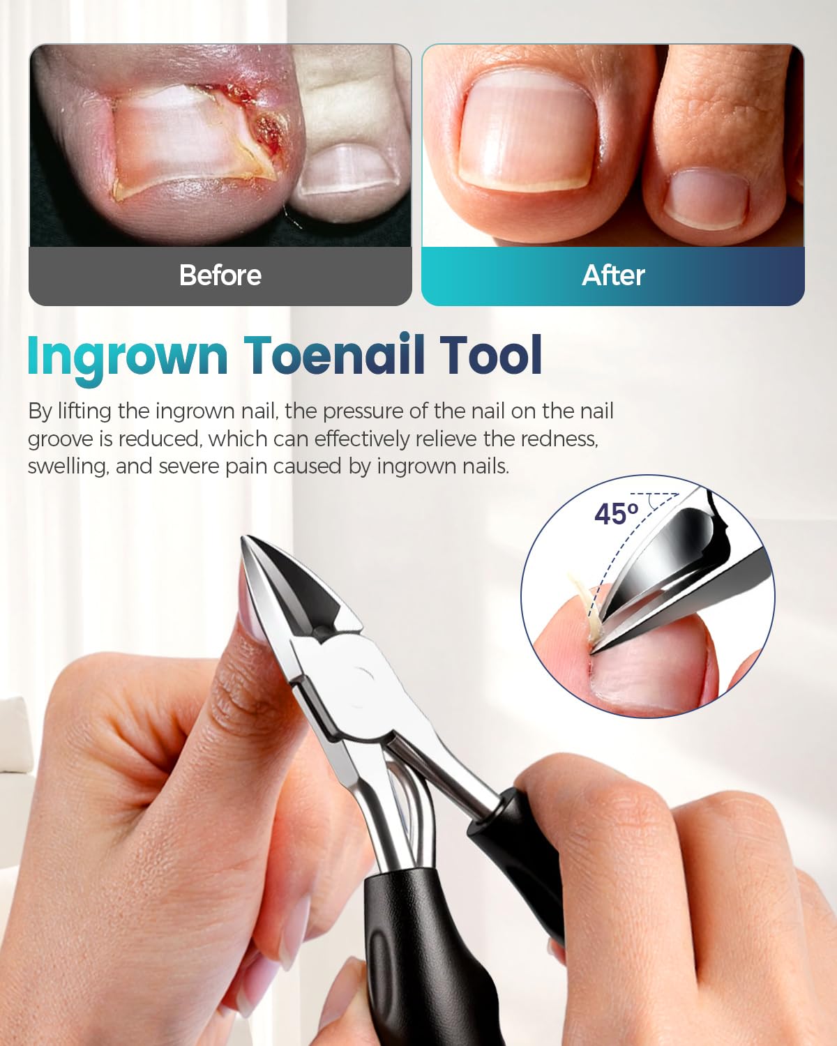 Detailed shot of the physical correction patches and breathable U shaped strips included in the professional toenail corrector set.