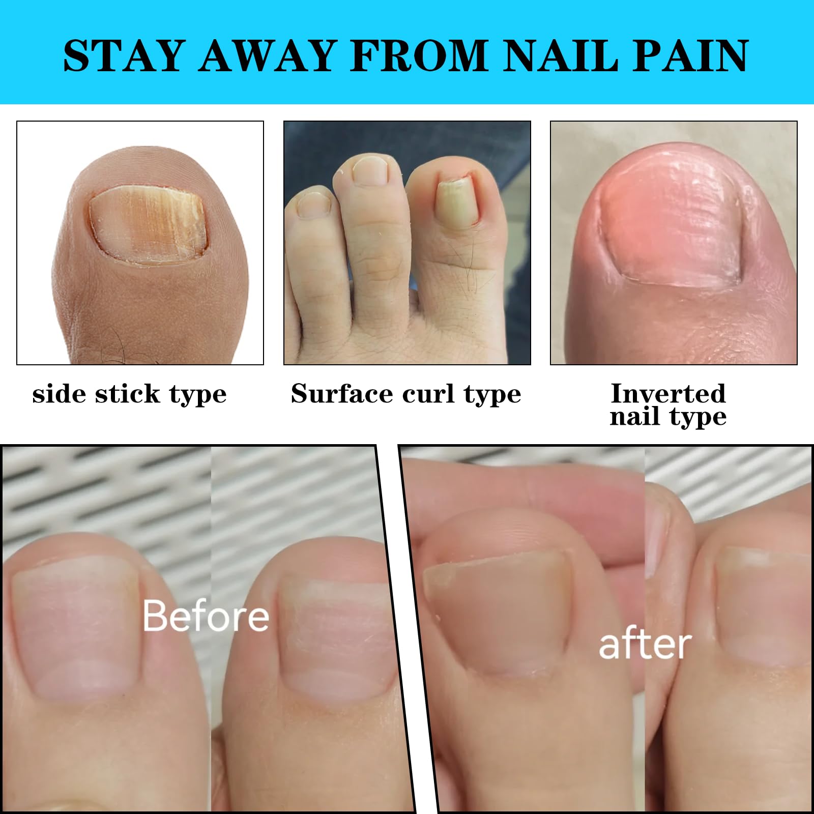 Professional surgical-grade stainless steel toenail lifter tool