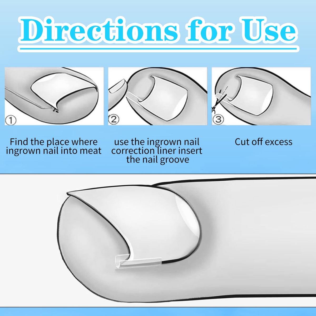 Authentic Abeillo ingrown toenail removal kit packaging