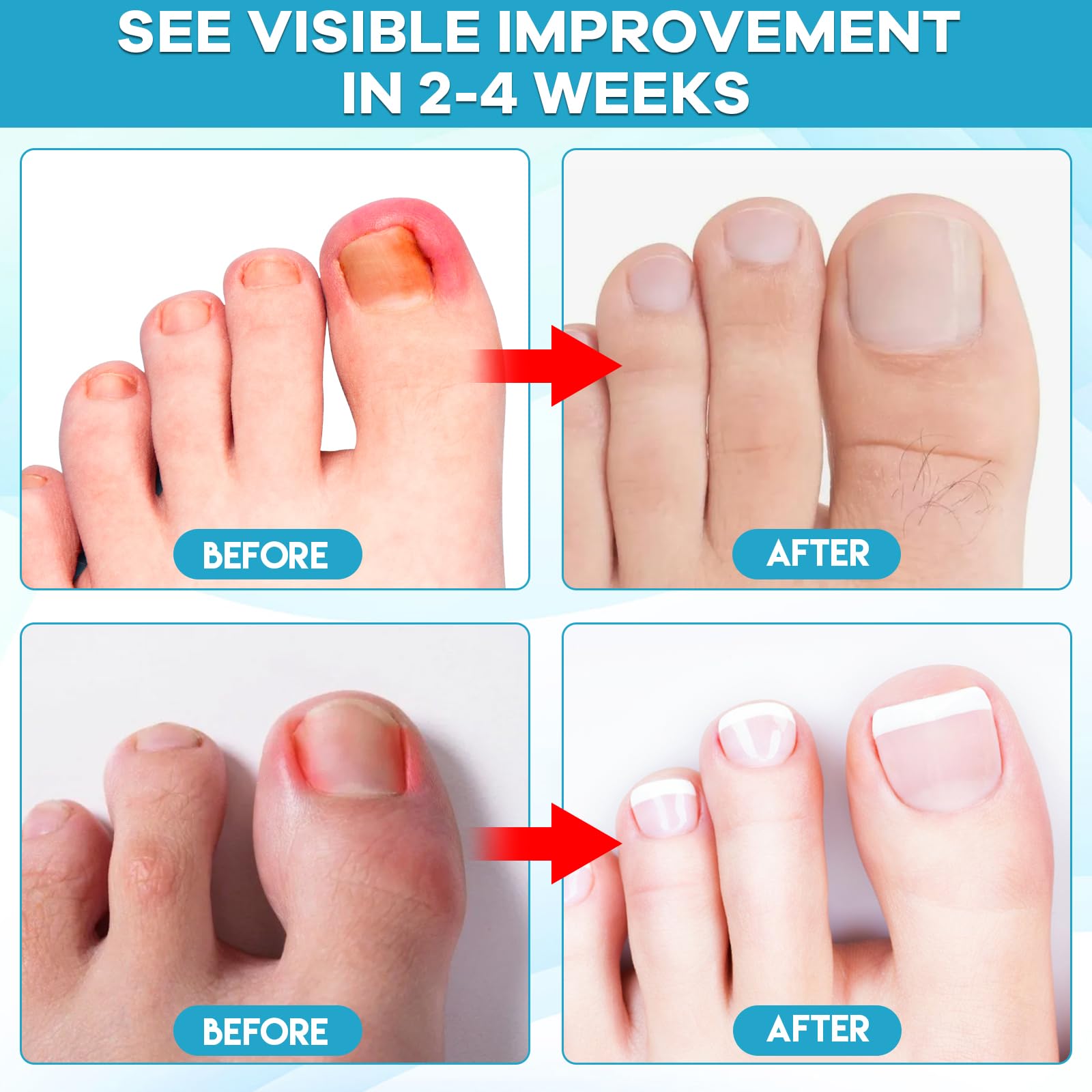 Maliyscent ingrown toenail treatment kit for professional nail care