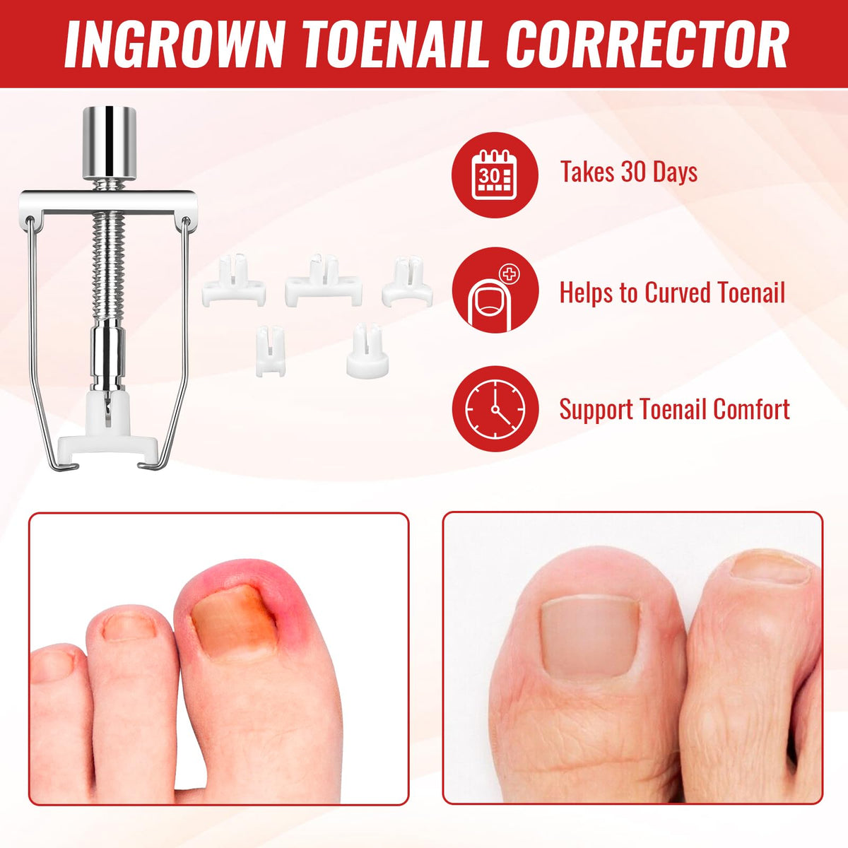 Professional ingrown nail treatment kit packaging