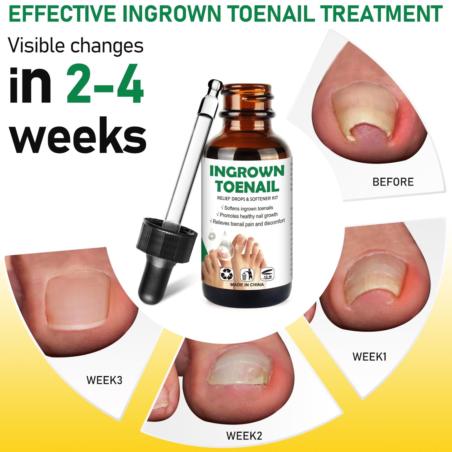 Packaging of Totclear ingrown toenail removal kit for men and women