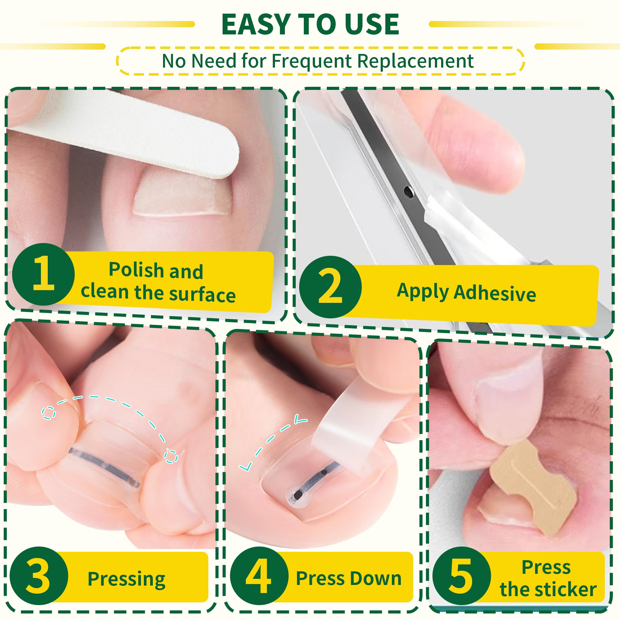 Applying fuzzycare memory patch on toenail