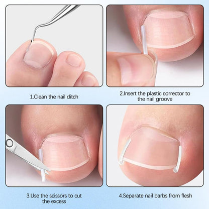 Demonstration of the BSolus alignment equipment correcting curved toenails safely.