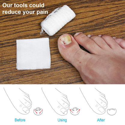 Close up of gold ingrown toenail corrective clamp