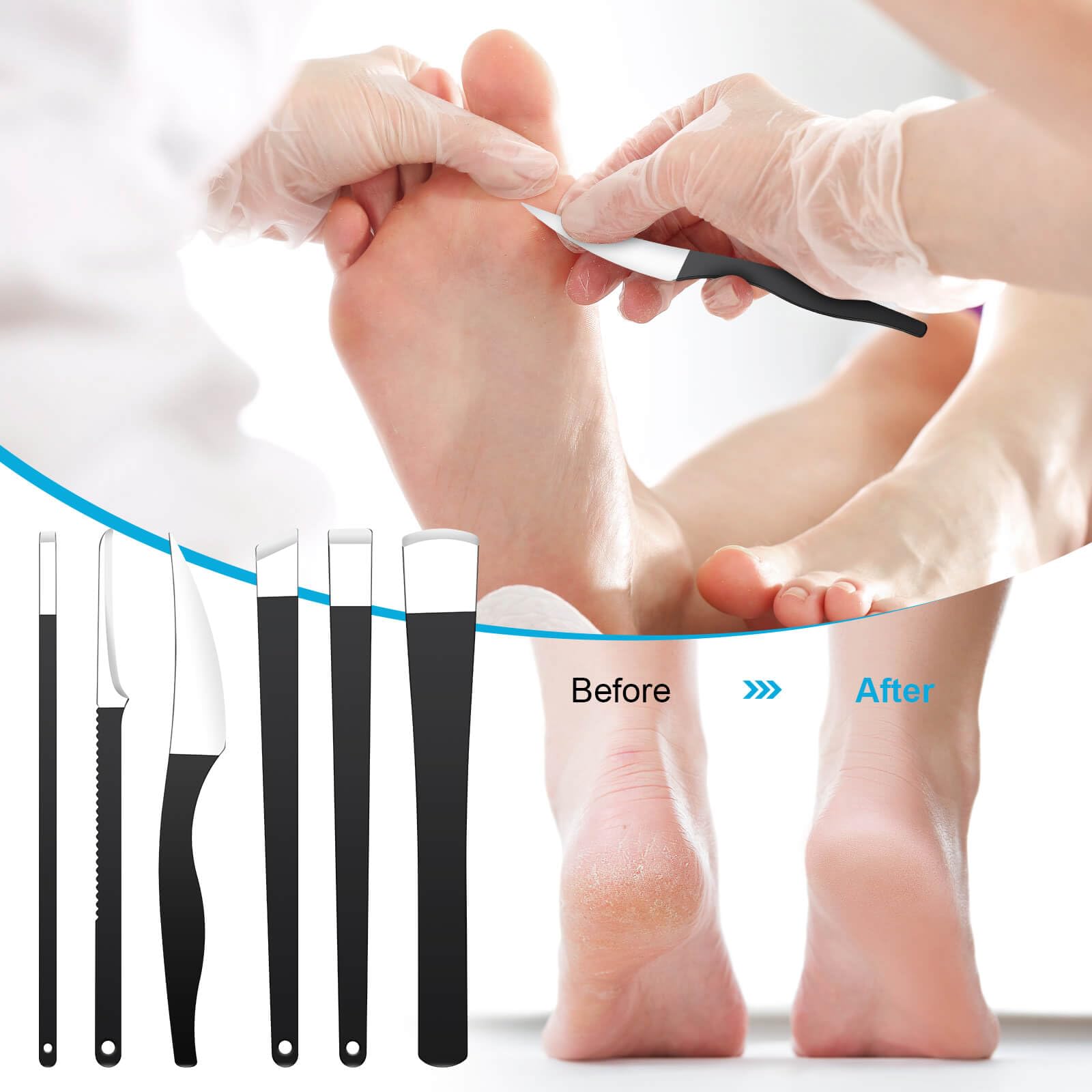 Professional callus shaver and ingrown toenail removal kit displayed on a clean surface