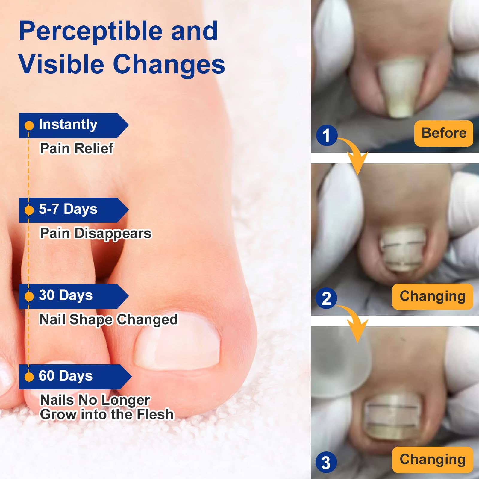 Tools for at home toenail straightening included in Yanxifei kit