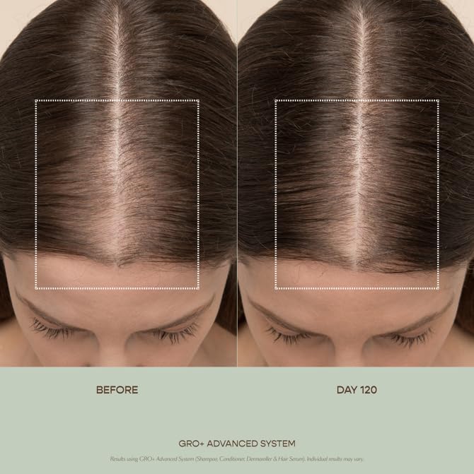 Dermatologist co-developed Vegamour scalp exfoliating shampoo for severe shedding