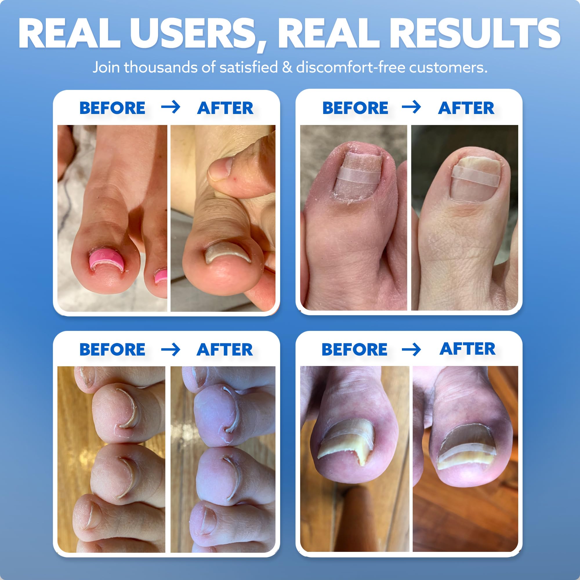 Ten clear medical grade braces for toenail correction