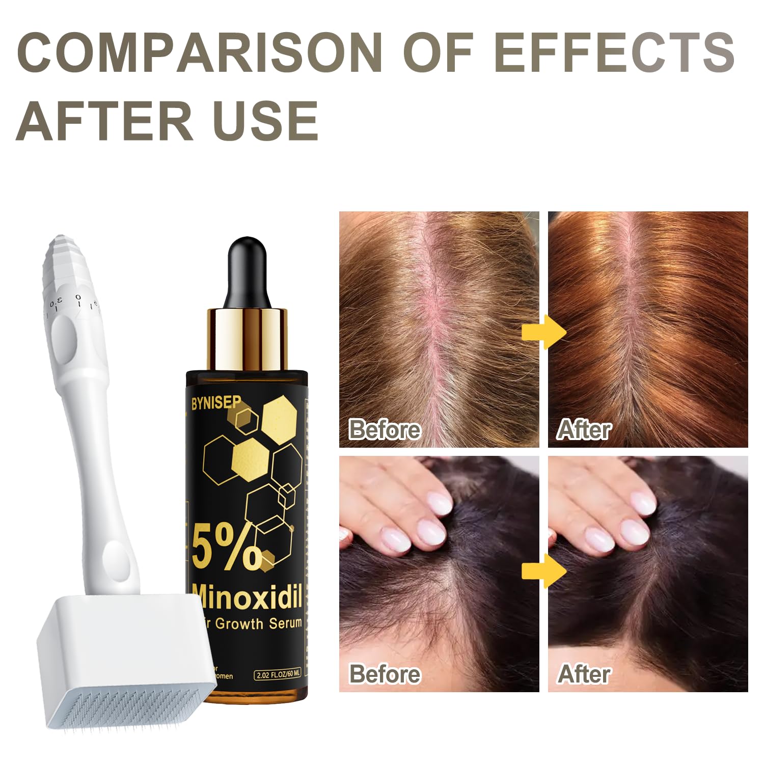Topical minoxidil and biotin formula for patchy beard follicle activation