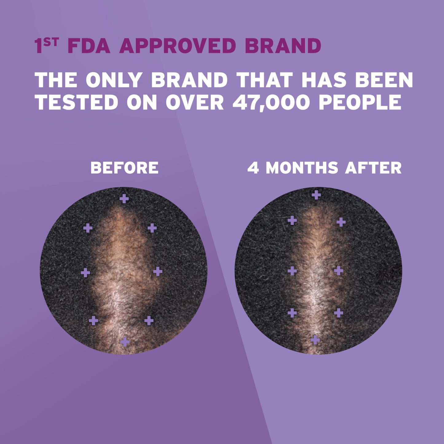 Dermatologist recommended daily hair growth solution for women with hereditary hair thinning packaging details